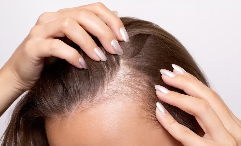Hair loss in women